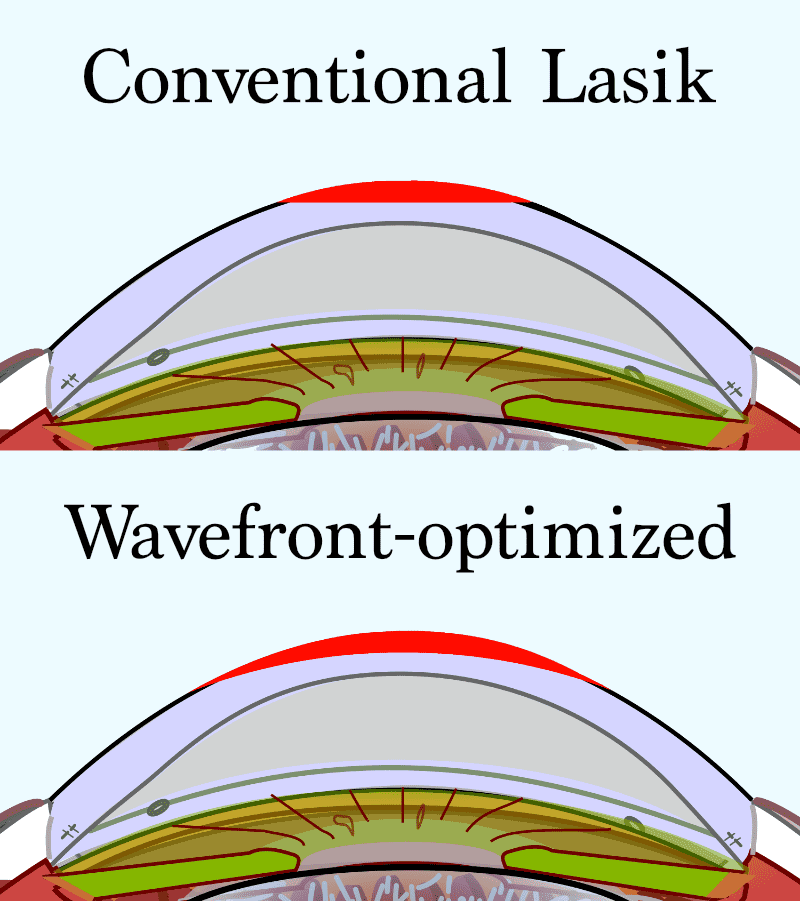 Conventional vs Wavefront-optimized Lasik