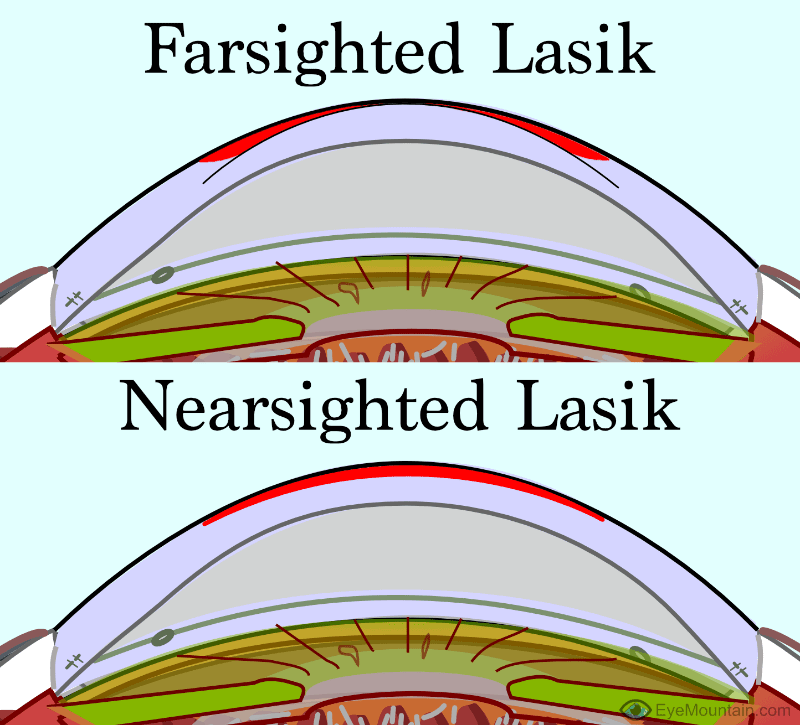 Difference between farsighted lasik treatment and nearsighted lasik treatment