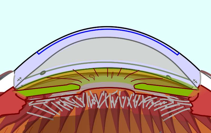 Side view of lasik flap