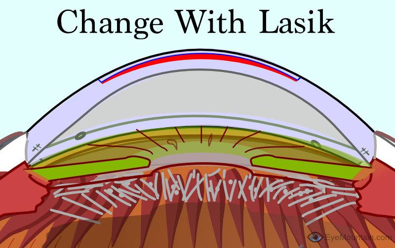 Flattening of cornea from lasik treatment