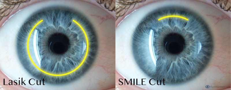 Difference in the size of the cut between lasik and smile