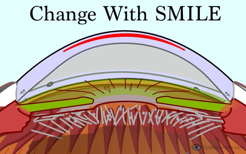 SMILE disc created within the cornea
